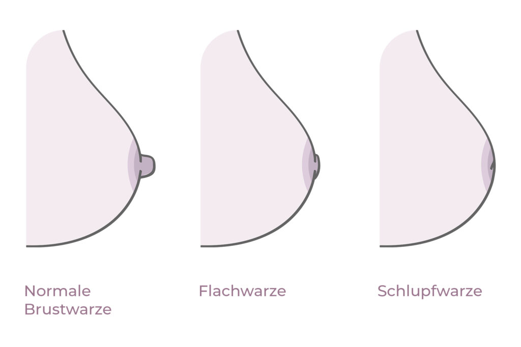 Grafik Vergleich normale Brustwarze, Flachwarze, Schlupfwarze
